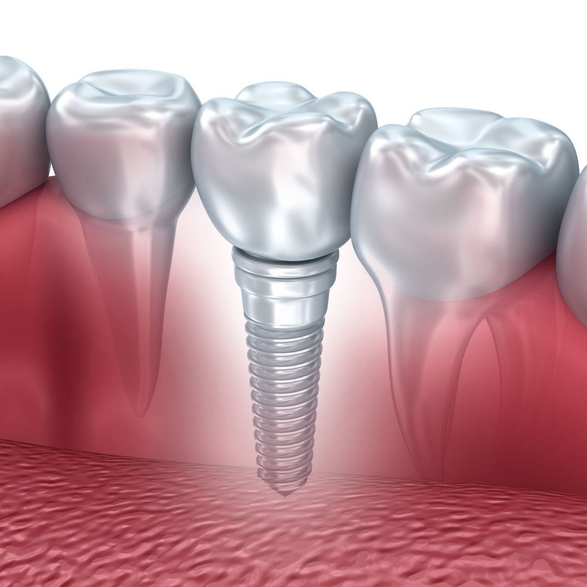 MHP'den Sağlıkta Dev Hamle: İmplant Tedavisi SGK Kapsamına Alınıyor