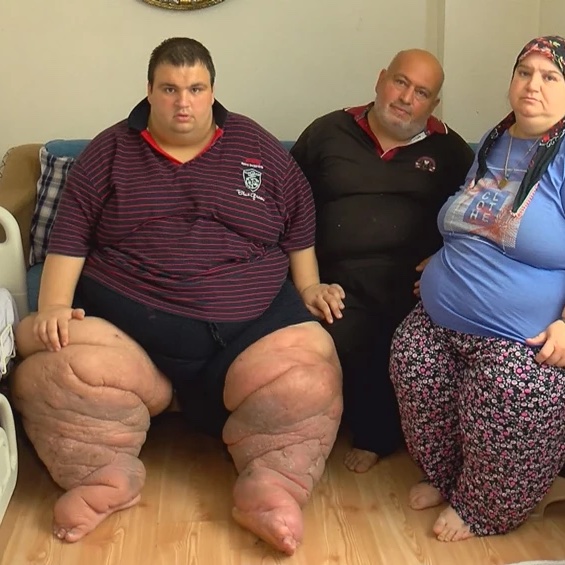 İstanbul'da Fil Hastalığına Yakalanan Genç Adam Yardım İstemiyor