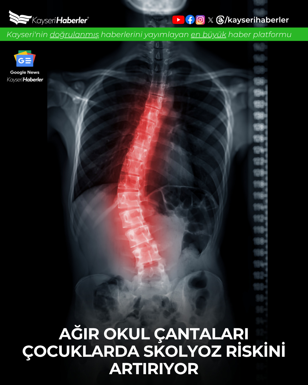 Okul Çantası Ağırlığına Dikkat: Çocuklarda Skolyoz Riski